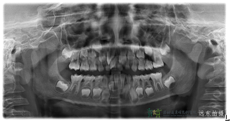 换牙期不重视孩子失去的可不只是牙齿