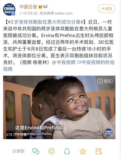 连体双胞胎