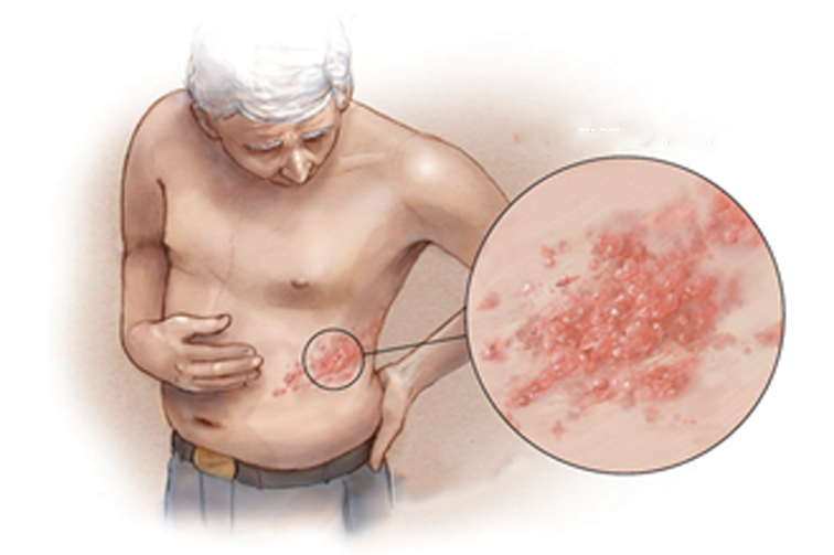 带状疱疹患处初期会出现潮红斑,而后出现粟粒至黄豆大小丘疹,成簇